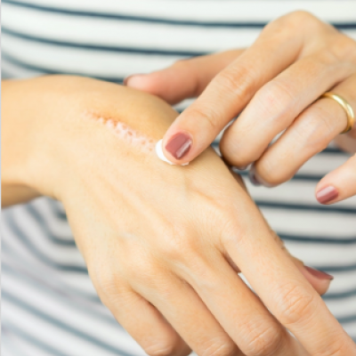 Home Remedy For Skin Burn