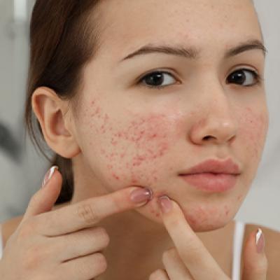 Home Remedies For Acne​