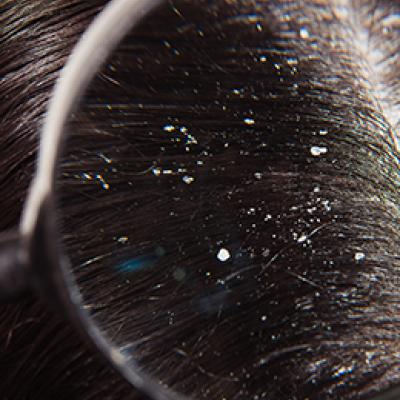 Home Remedies For Dandruff